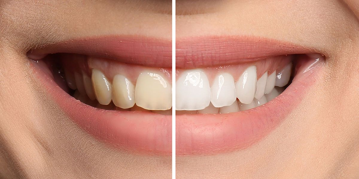 Teeth Whitening | Tijuana