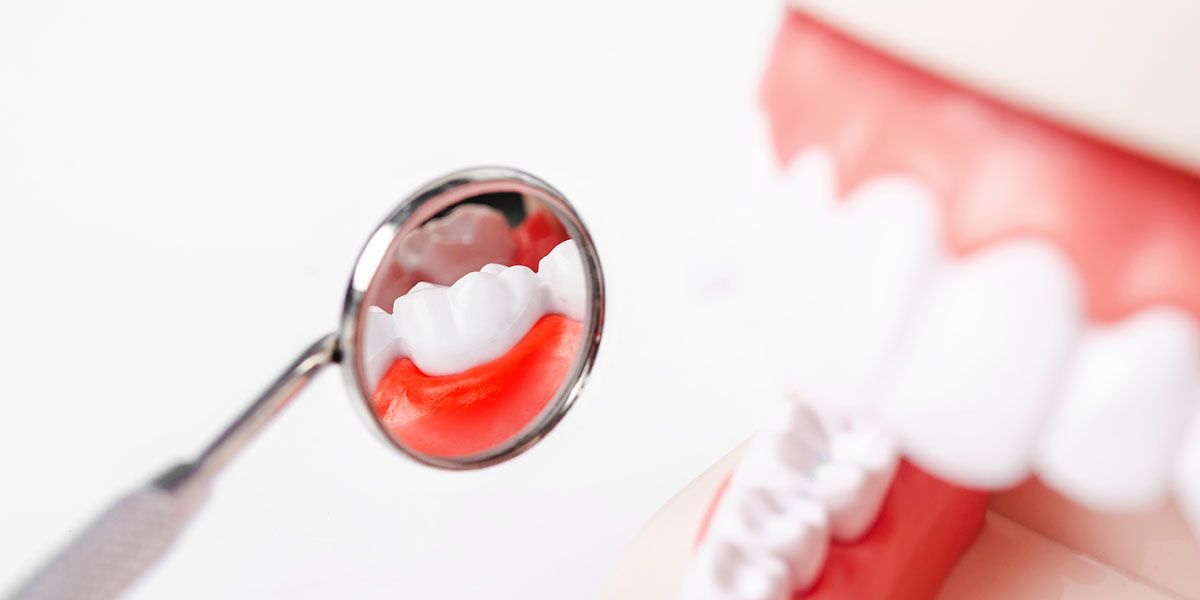 Gum Care | Tijuana Dentist