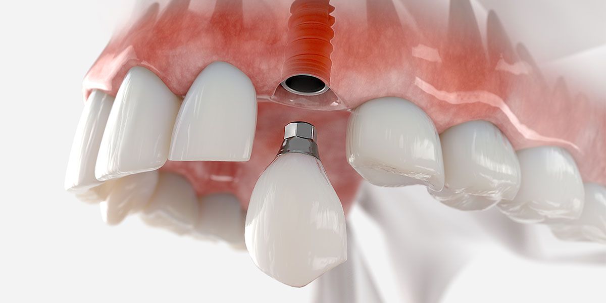 Dental Implant | Tijuana