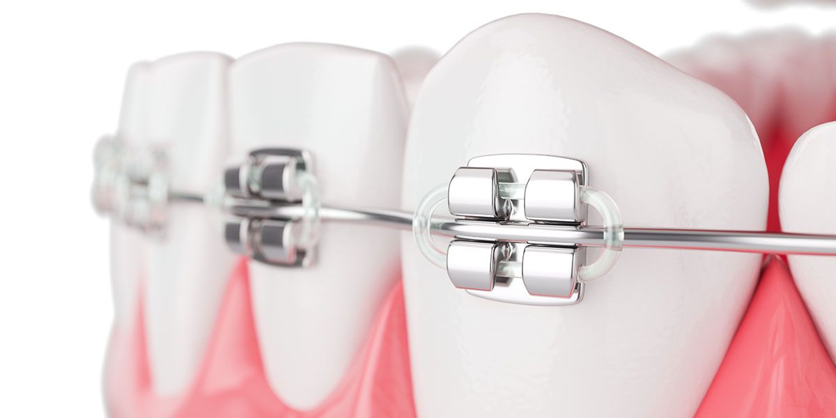 Orthodontics | Tijuana Dentist