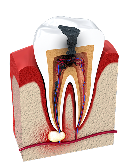 Endodontics | Tooth Pulp