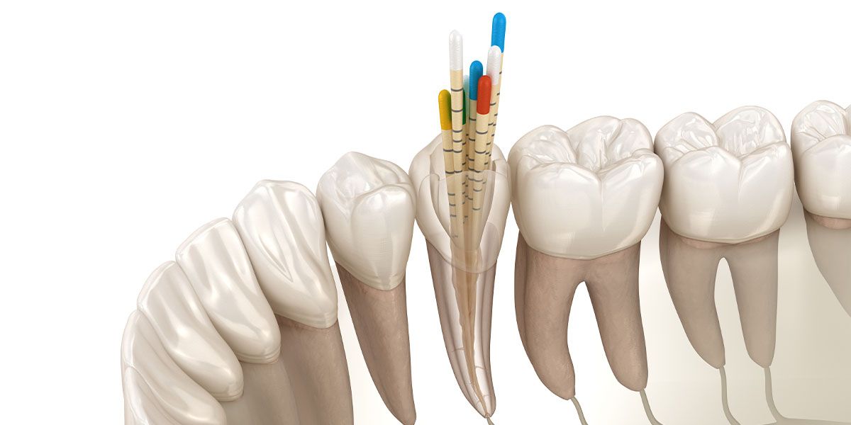 Root Canal Therapy | Tijuana